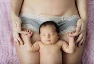 Caesarean Delivery in Delhi by Dr Bhumika Shukla