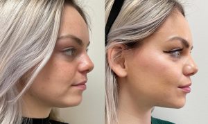 Unveiling the Timeless Elegance: A Journey Through Facelift in London