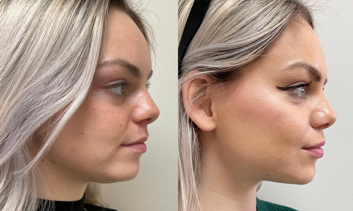 Facelift in London