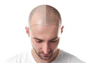 The Ultimate Guide to Hair Transplant in Dubai: Restoring Confidence with the Latest Techniques